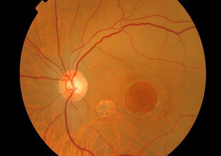 Illustration d'un trou maculaire, une affection oculaire caractérisée par une déchirure dans la macula, la région centrale de la rétine, pouvant entraîner une perte de vision centrale