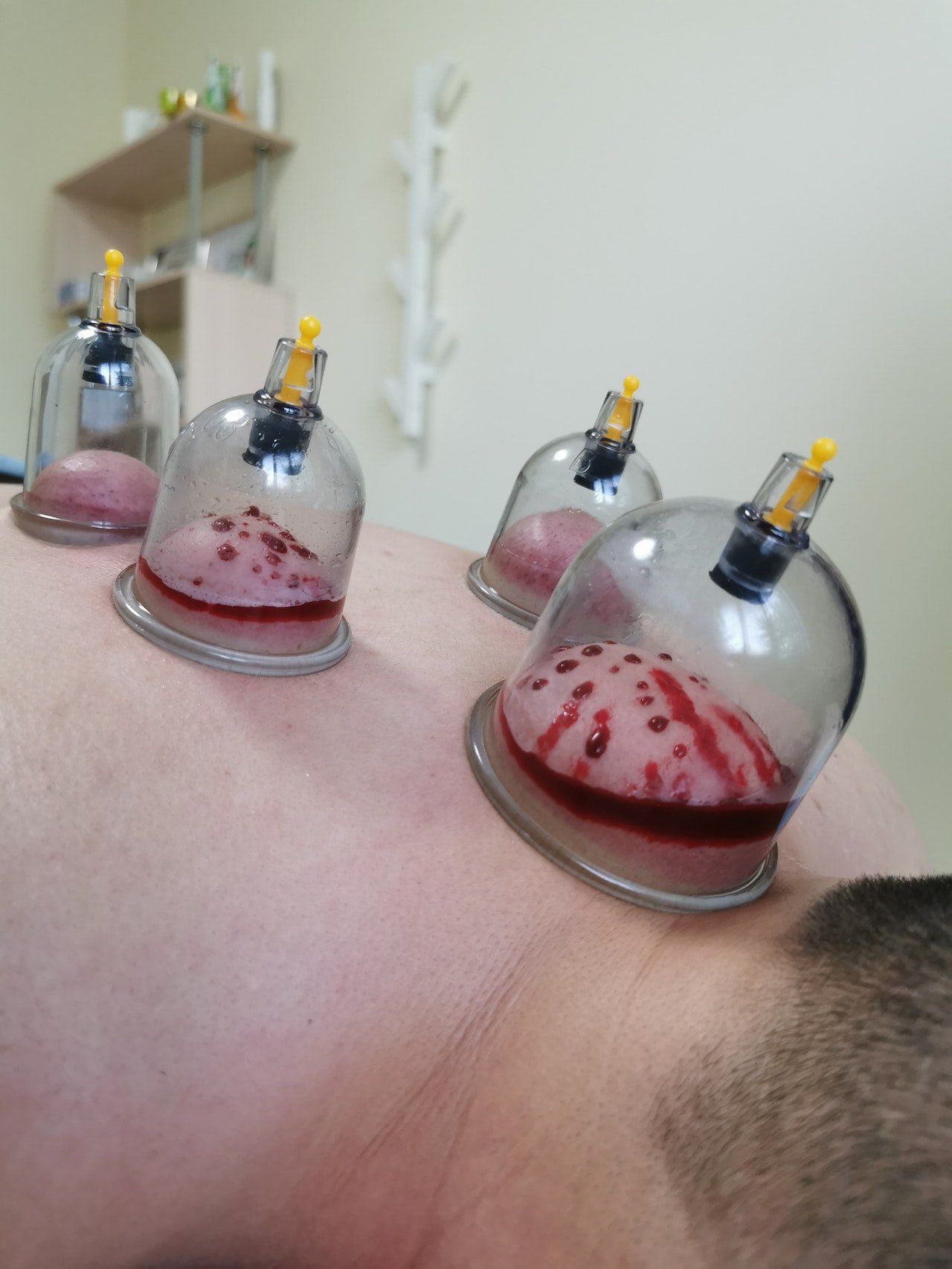Hijama humide Hijama humide