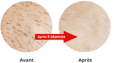 Holidayskins epilation lumiere pulsee pas cher poil