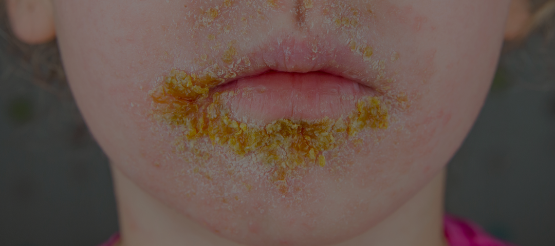 Boca de un niño afectada por el impétigo