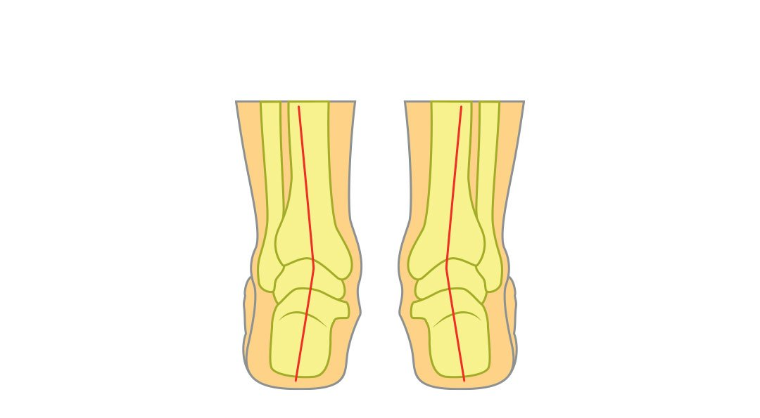 Flat Foot