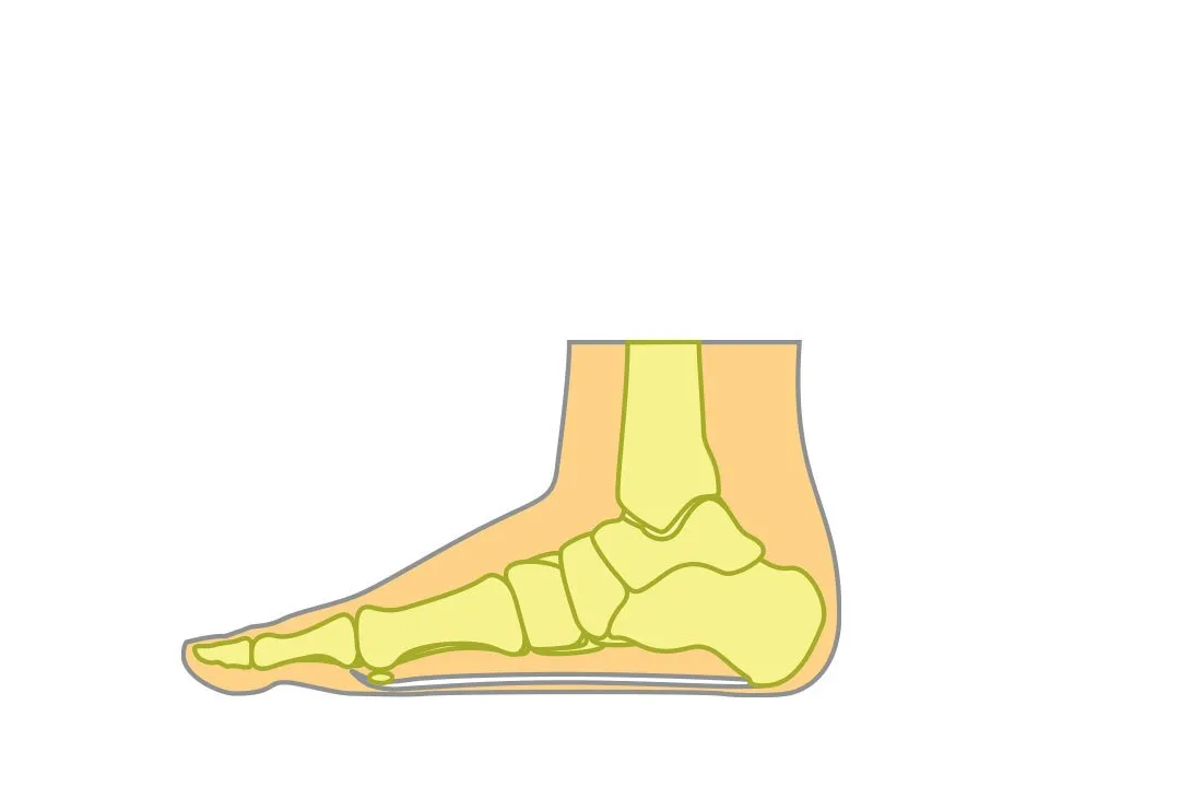 Flat Foot