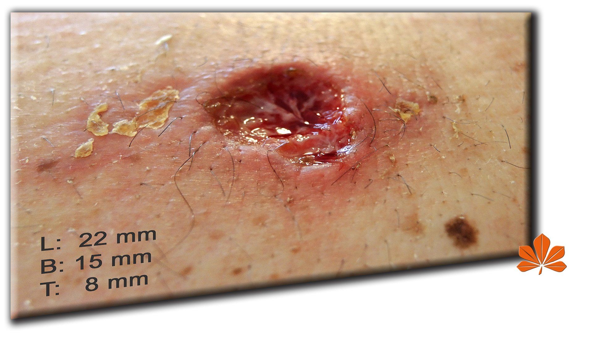 Therapie Hautkrebs Schwarze Salbe