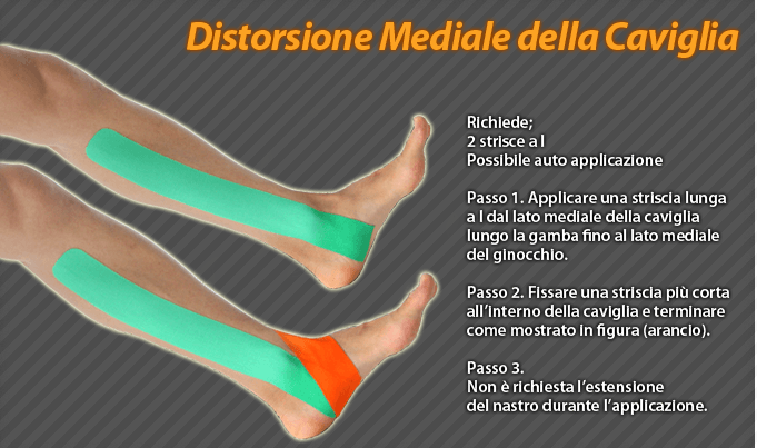 distorsione mediale della caviglia