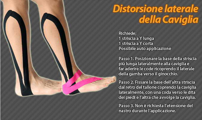 distorsione laterale della caviglia