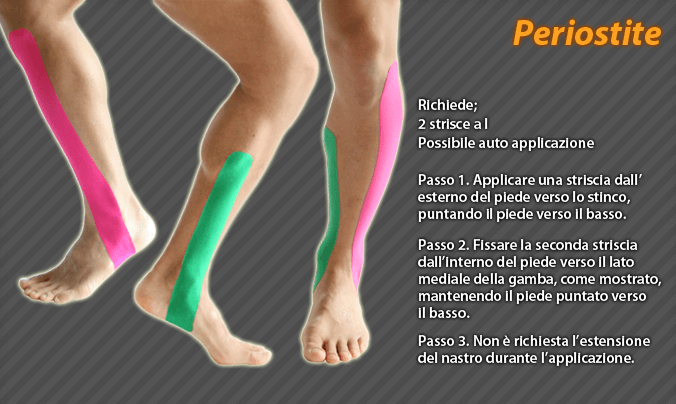 periostite