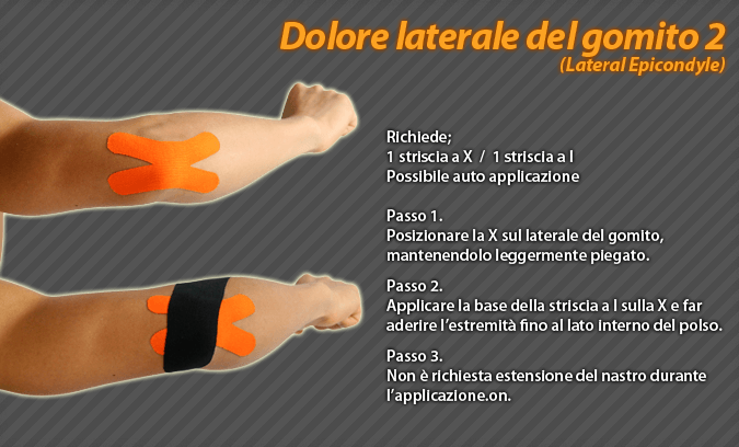 dolore laterale del gomito