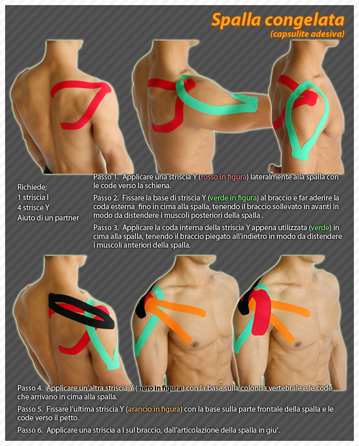 spalla congelata capsulite adesiva