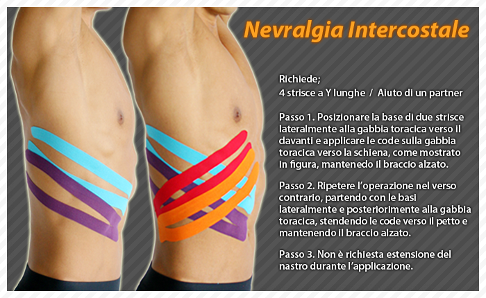 nevralgia intercostale