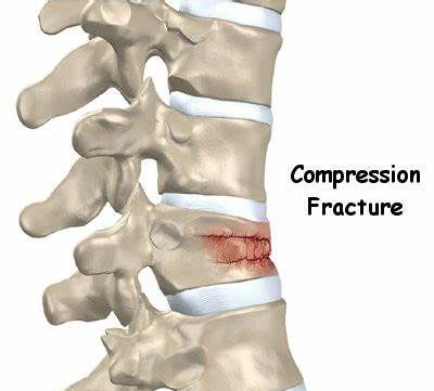 Illustrazione delle vertebre con frattura da compressione per osteoporosi