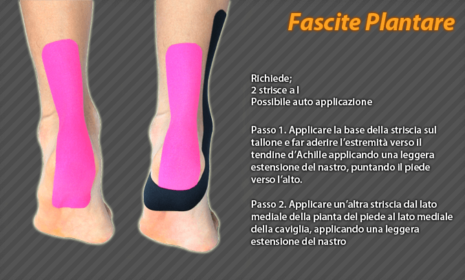 fascite plantare