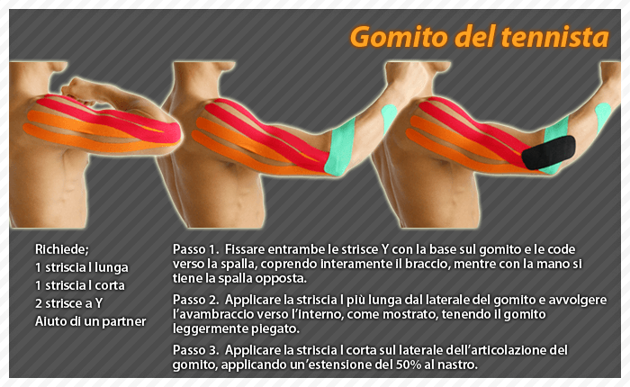 gomino del tennista epicondilite