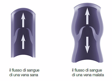 FLUSSO DI SANGUE calze terapeutiche