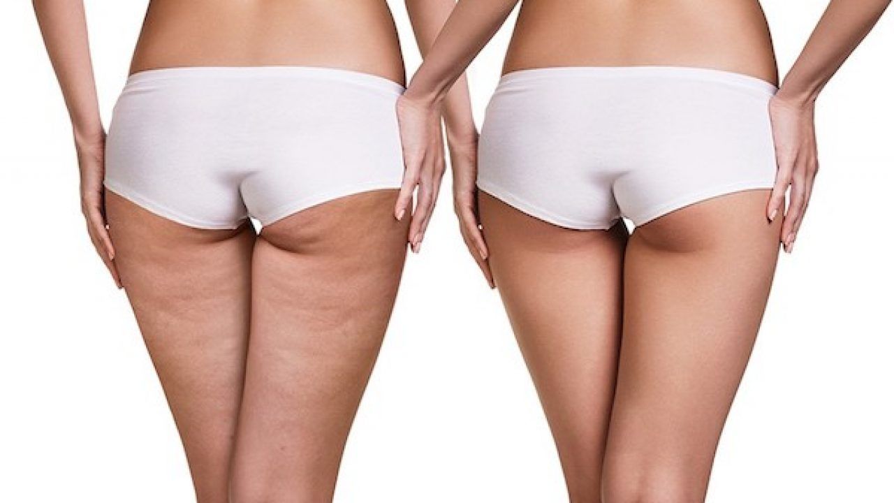Terapia contro la cellulite trattamenti per drenaggio microcircolo e tono cutaneo.