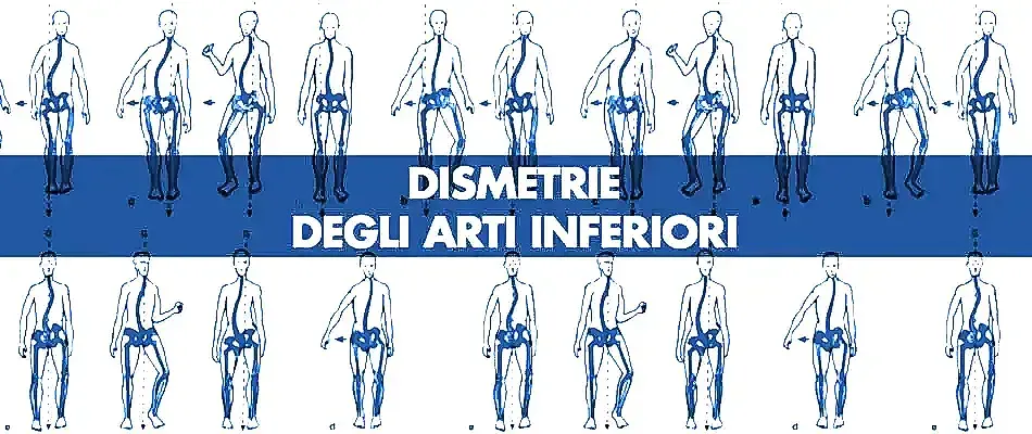 DISMETRIE ARTI INFERIORI
