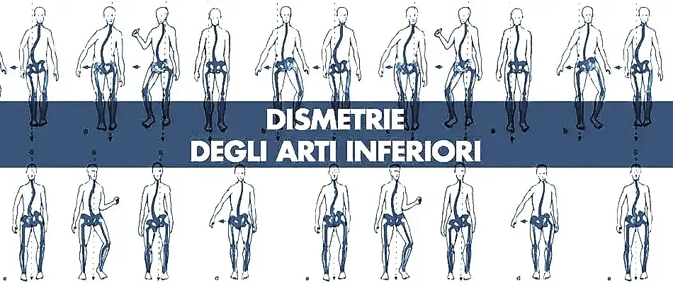 DISMETRIE ARTI INFERIORI