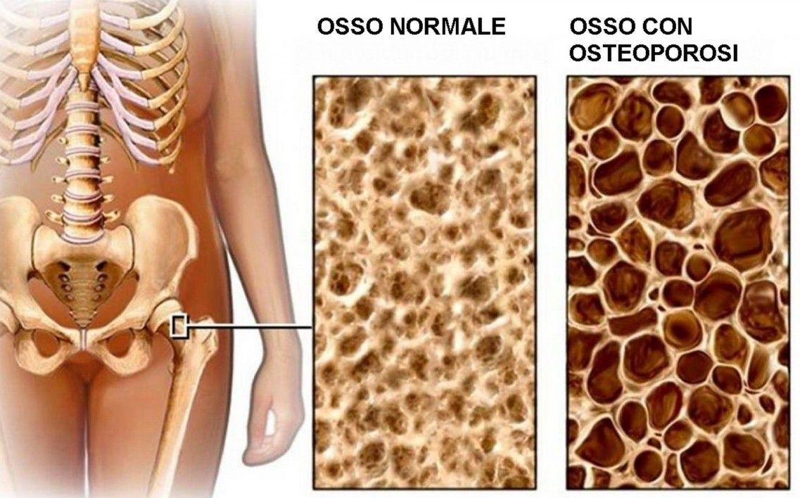 OSTEOPOROSI-ORTOPEDIA CIBRARIO