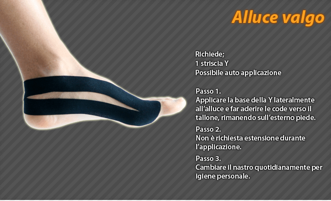 alluce valgo