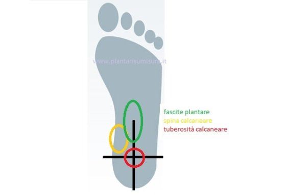 Fascite plantare, spina calcaneare o tuberosità calcaneare: come distinguerle?