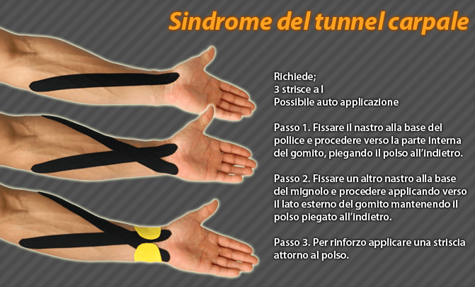 sindrome del tunnel carpale