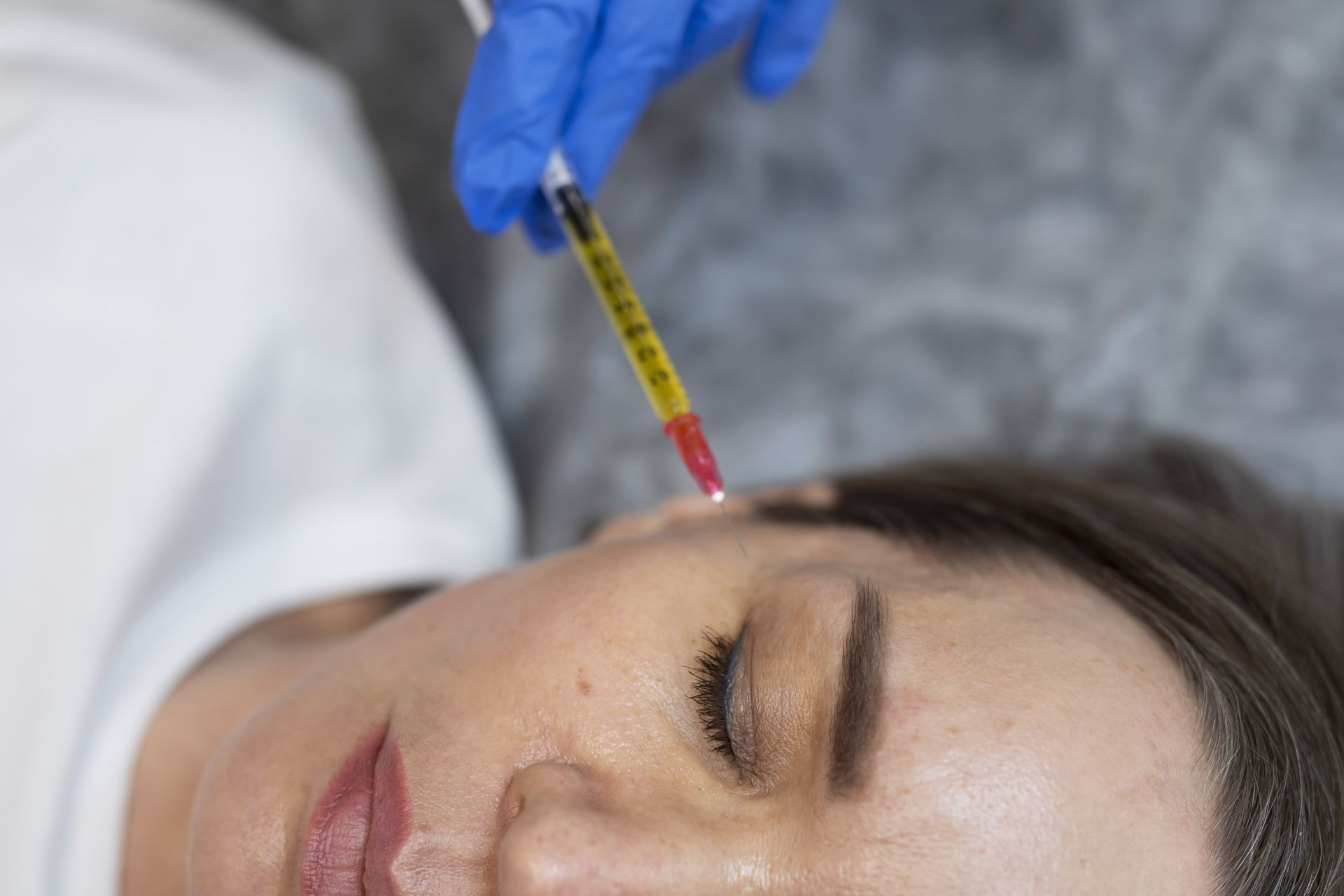 Aplicaciones variadas de Plasma rico en Plaquetas en Medicina estética facial y armonización facial