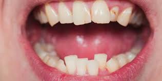 apinamiento-dental-medidental-plus
