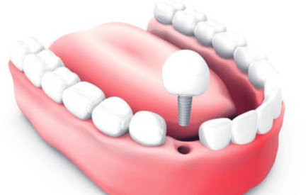 fijacion-implante-dental-medidental-plus