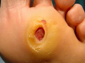 Mal perforante plantar