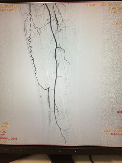 ArteriografÃa tÃpica de patrón oclusivo distal