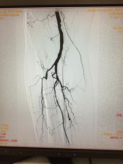 Arteriografía típica de patrón oclusivo distal