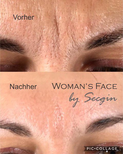 Accor-Plasma-Pen-Behandlung Straffung der Zornfalte