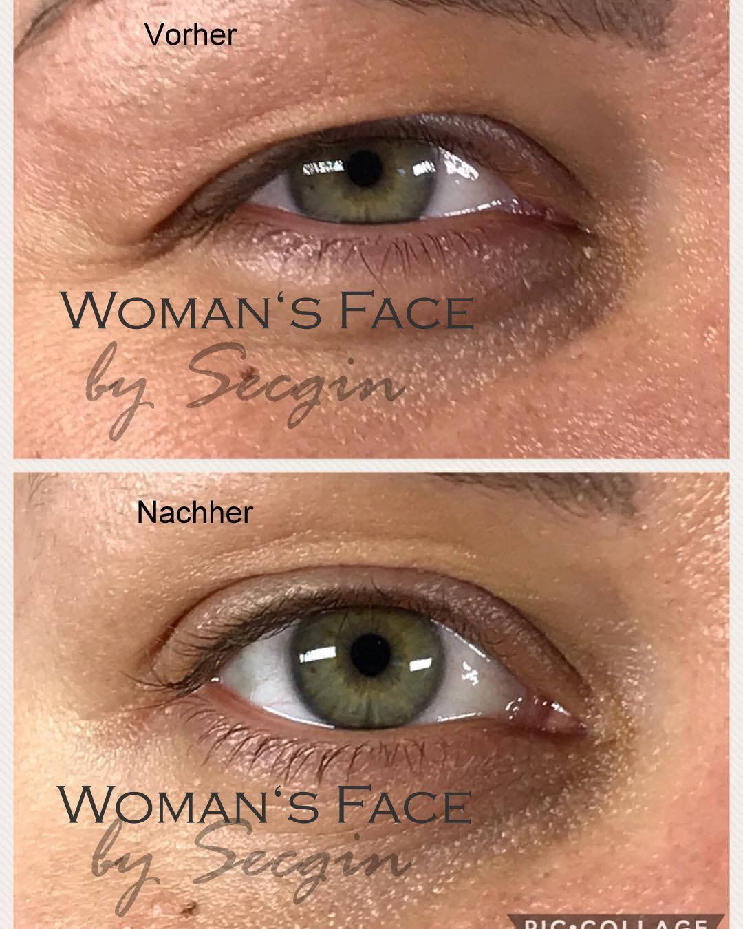 Accor-Plasma-Pen-Behandlung Oberlidstraffung