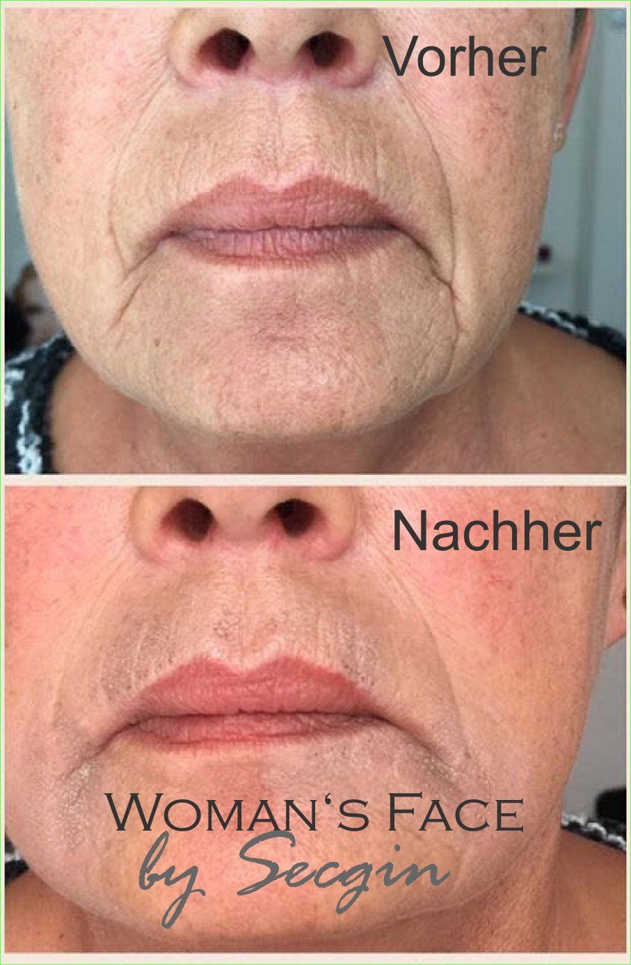 Accor-Plasma-Pen-Behandlung Straffung der Nasolabialfalten