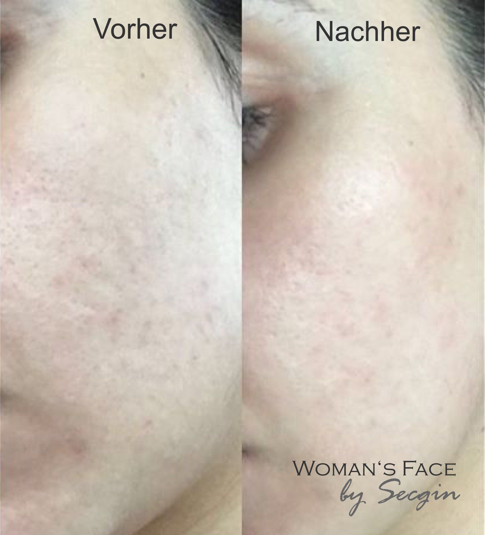 Verbesserung des Hautbilds Fire & Ice Behandlung