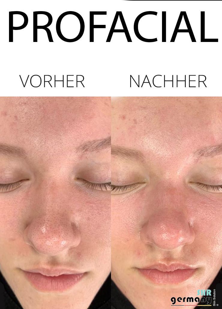 Kosmetik Rosenheim - ProFacial Vergleich 1