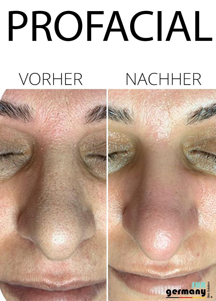 Kosmetik Rosenheim - ProFacial Vergleich 2