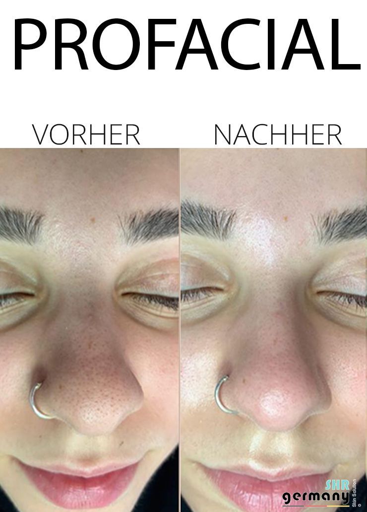 Kosmetik Rosenheim - ProFacial Vergleich 3