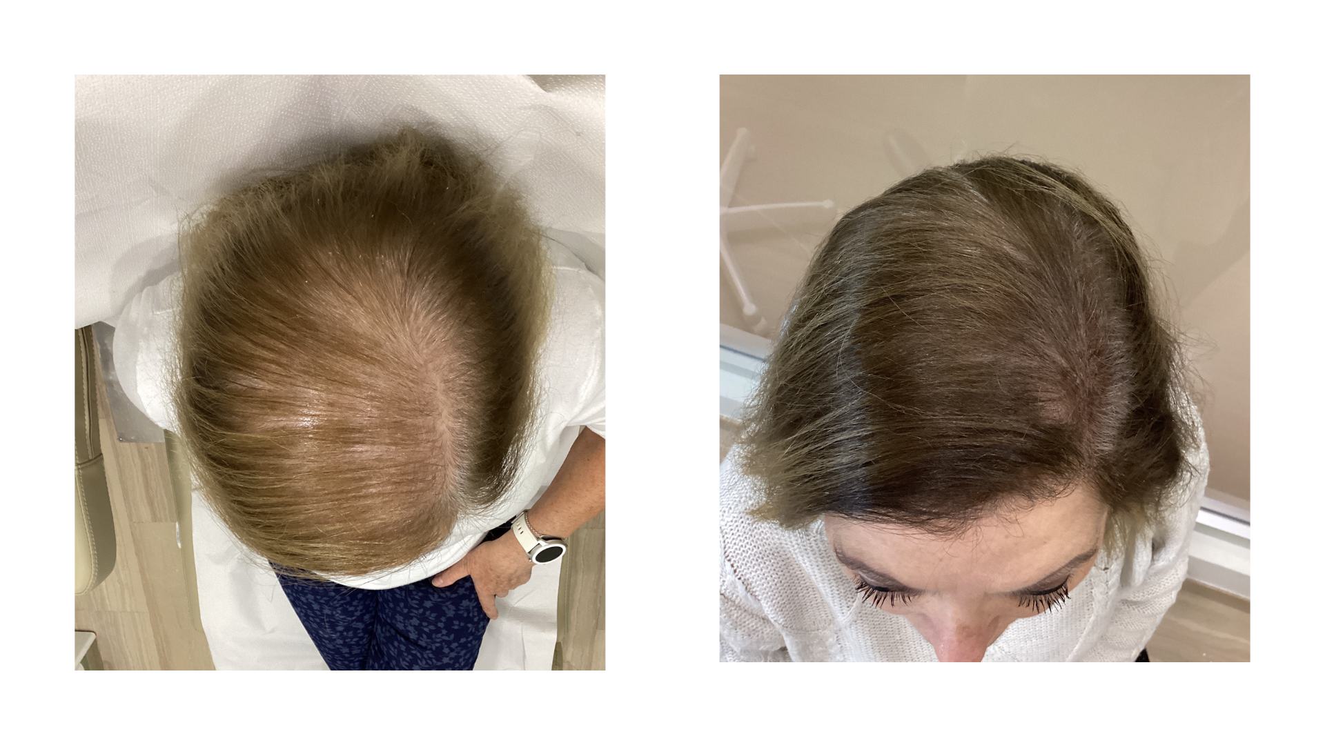 Foto de antes y despues de alopecia androgenica mujer.