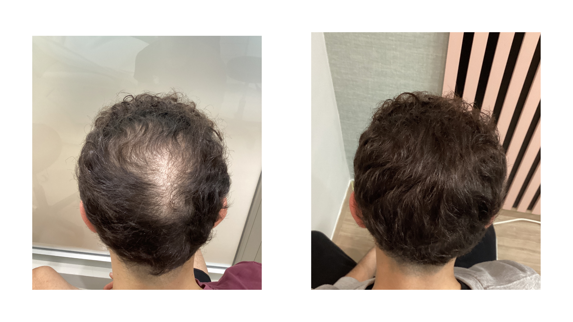 Foto de tratamiento capilar