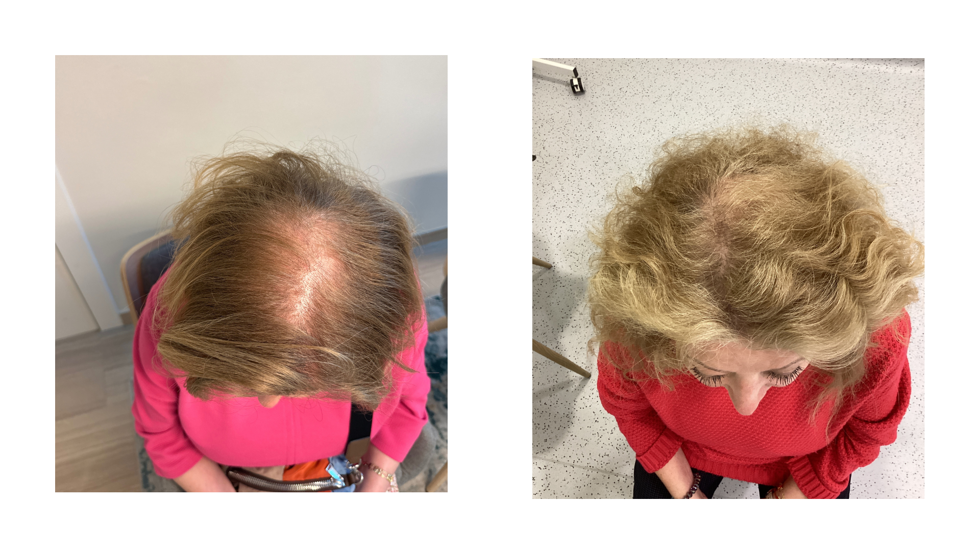 Foto antesy despues del tratamiento de alopecia en mujer