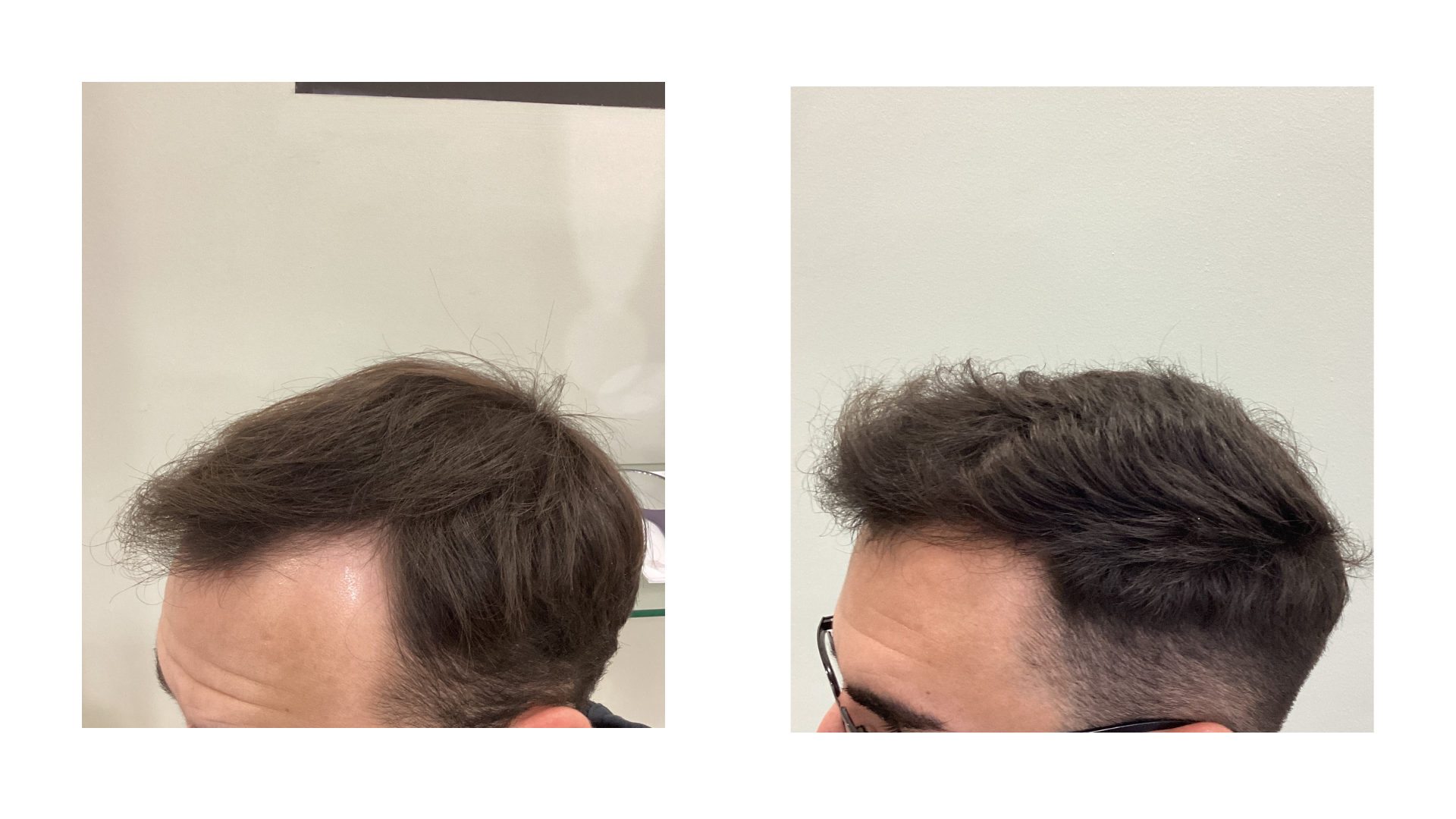 foto Hombre 25 años. Antes y despues del tratamiento capilar de alopecia masculina.