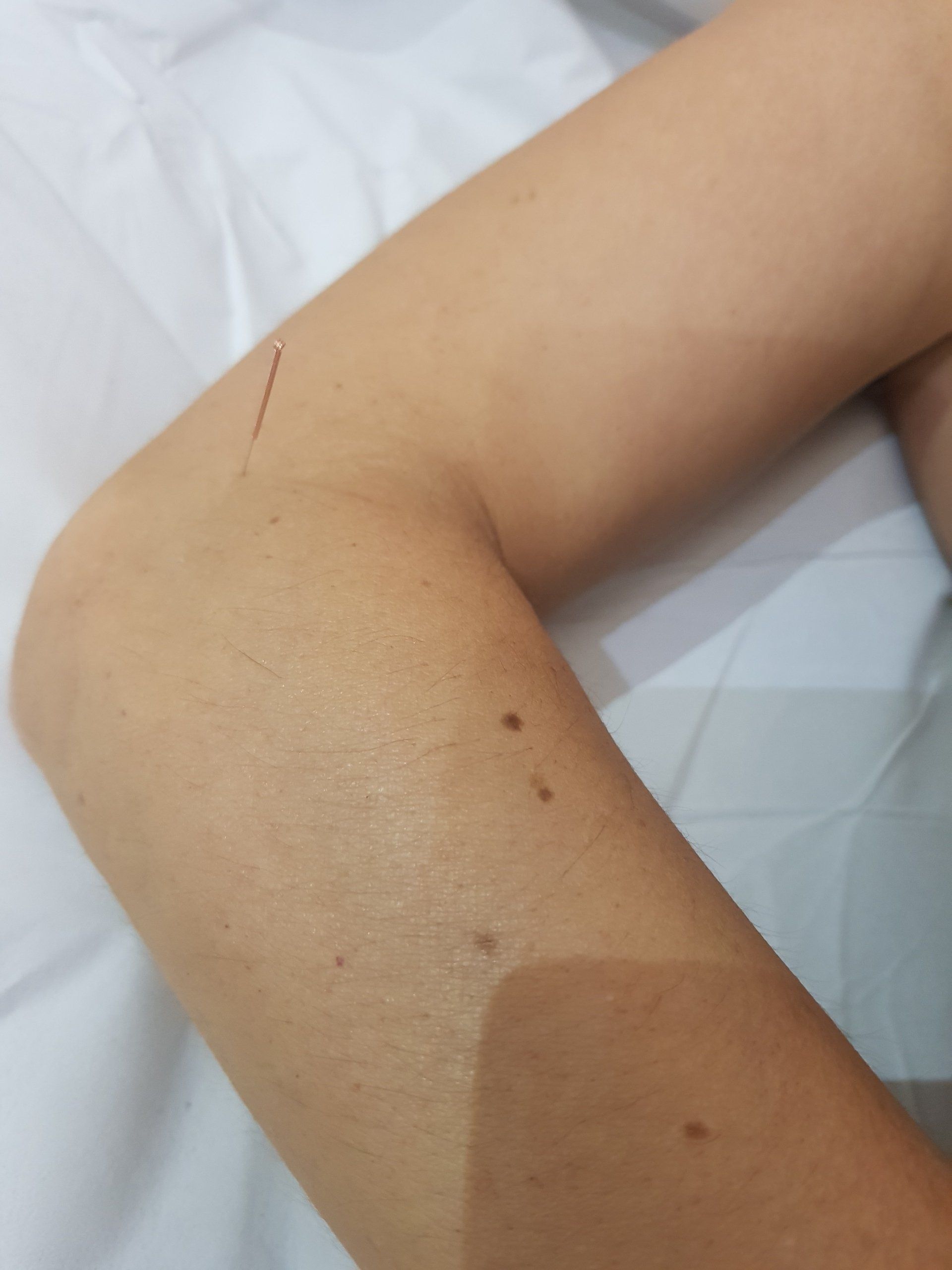 Punts d'acupuntura, aplicacions de l'acupuntura