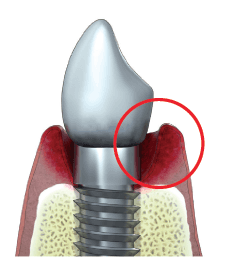 Zahnimplantat Entzündung