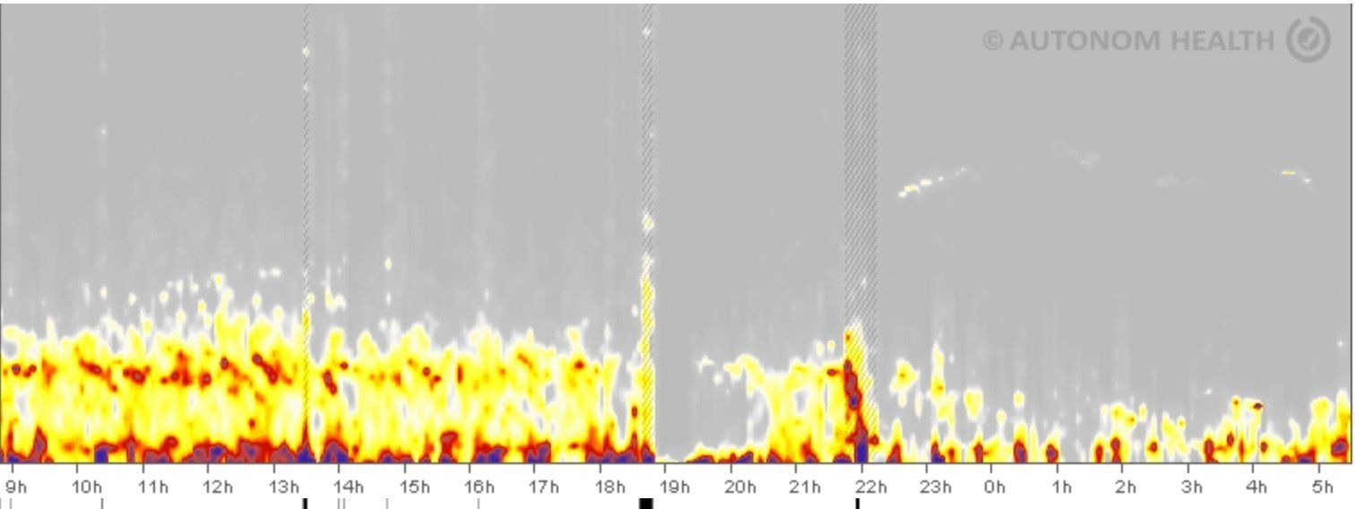 Herzratenvariabilität