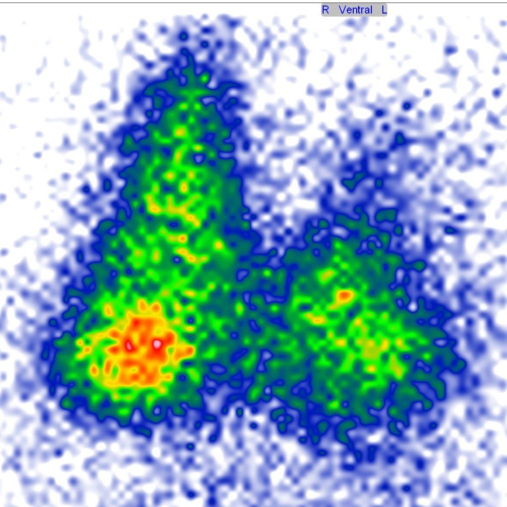 Schilddrüsenzintigraphie