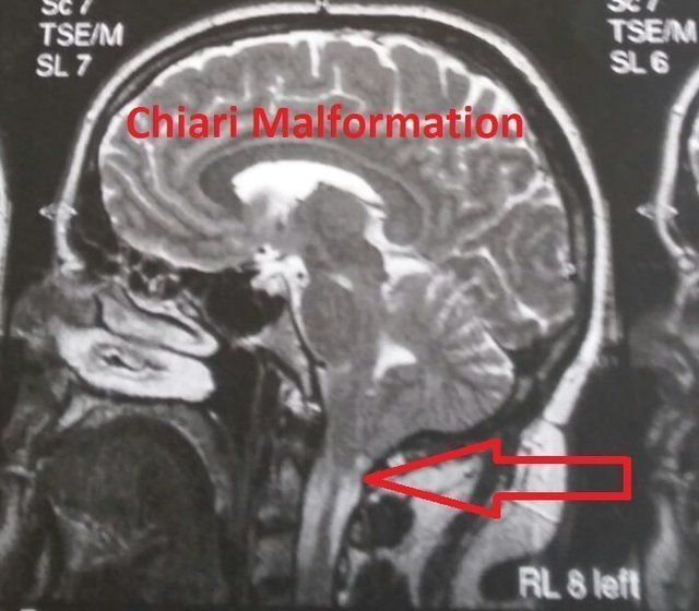 Chiari Malformation MRT