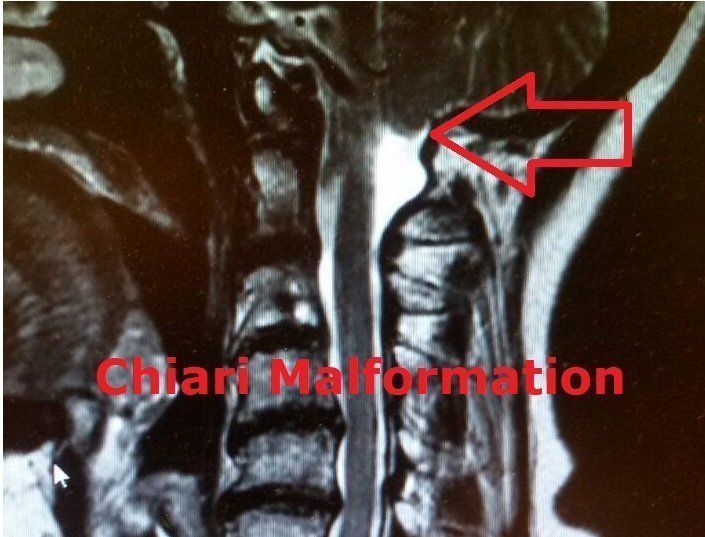 MRT Chiari Malformation
