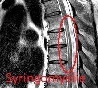 MRT Syringomyelie