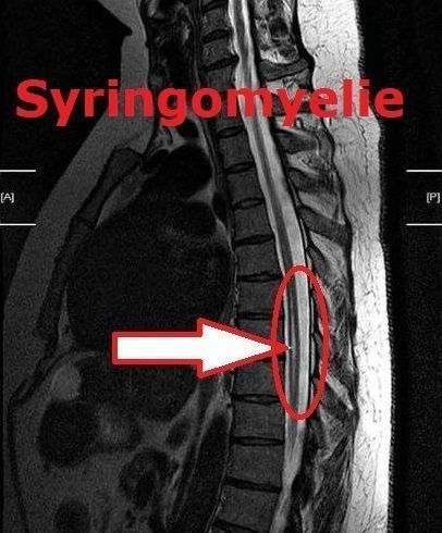 MRT Syringomyelie