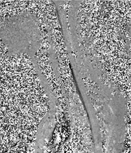 dynamische Kernspintomographie mit Liquorpulsations-messung